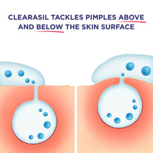 Load image into Gallery viewer, Clearasil Stubborn Acne Control 5in1 Concealing Treatment Cream, 1 oz. (Pack of 3)